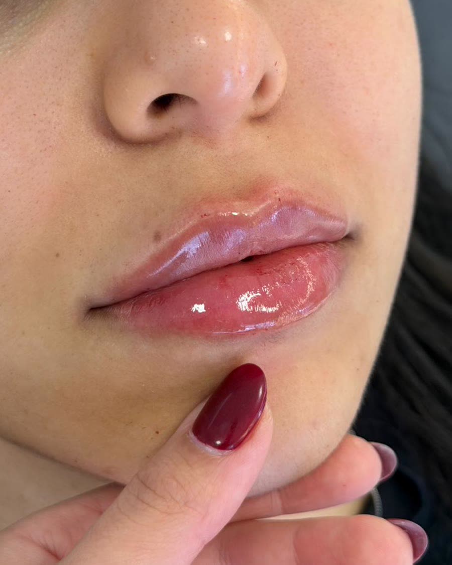 Depois do tratamento de preenchimento labial